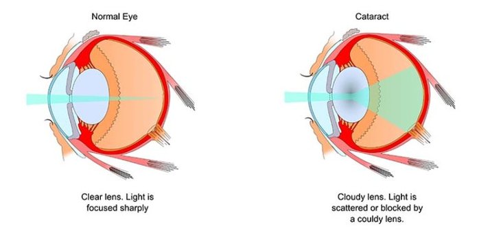 diagram of dog cataracts