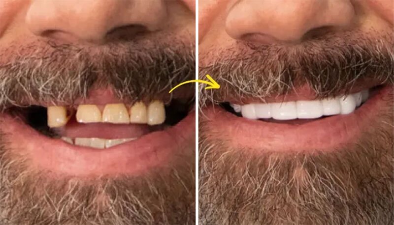 Shiny Smile Veneers