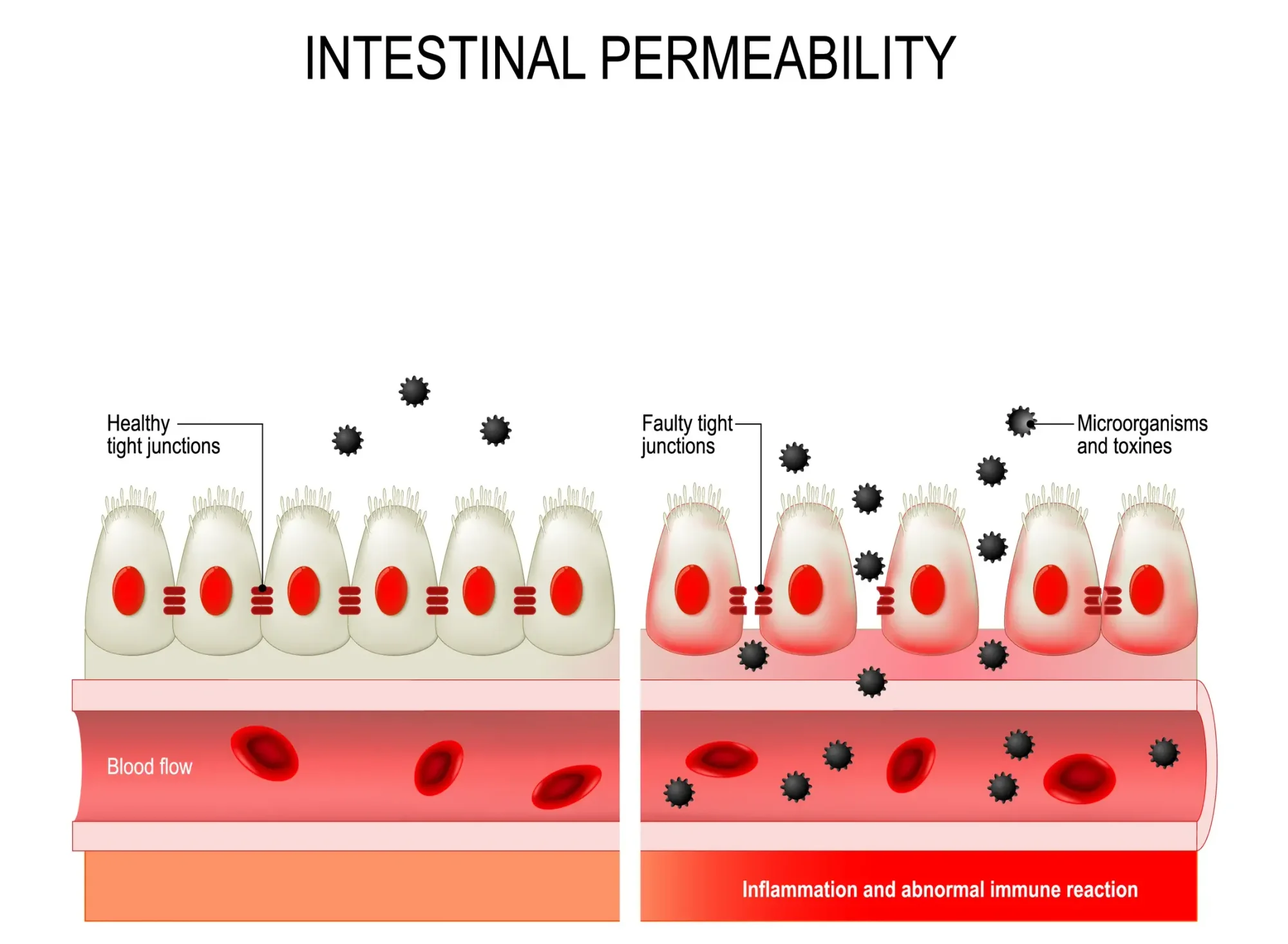 Intestinal Permeability Graphic