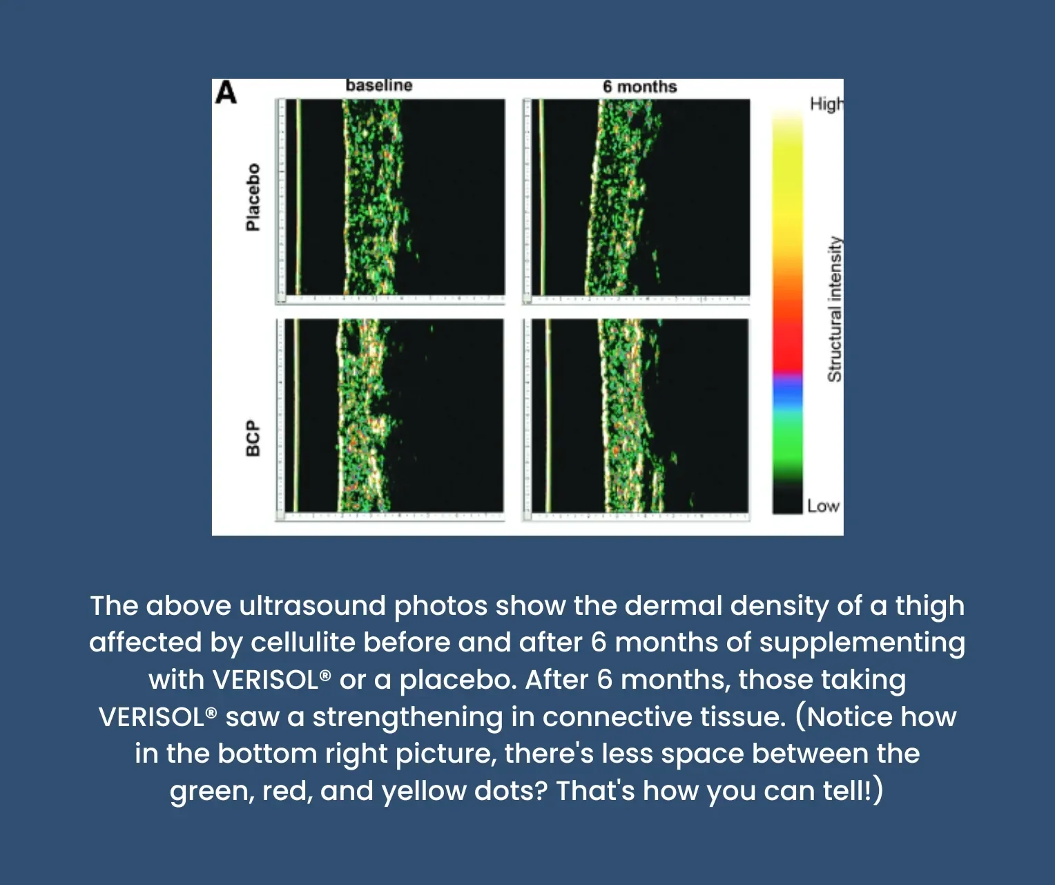 Before and after ultrasound photos of thigh cellulite in those taking either 2.5 grams of VERISOL® or a placebo for 6 months.