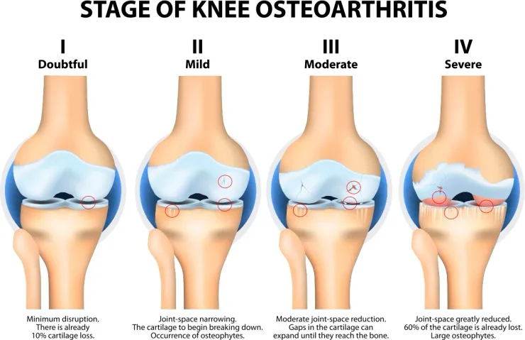 Animated graphic showing the difference between a normal joint and a joint with osteoarthritis.