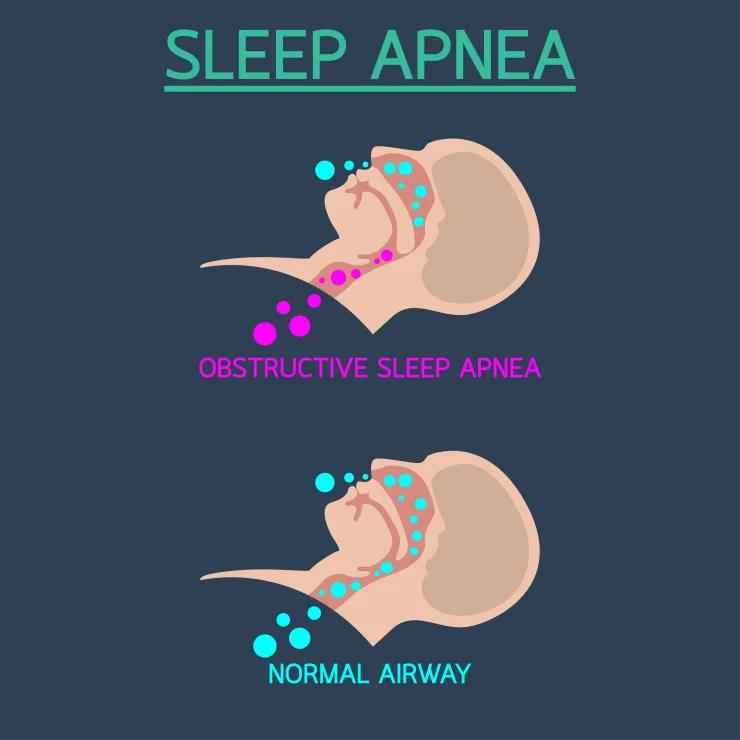 Sleep Apnea vector icon illustration: Obstructive Sleep Apnea vs. Normal Airway