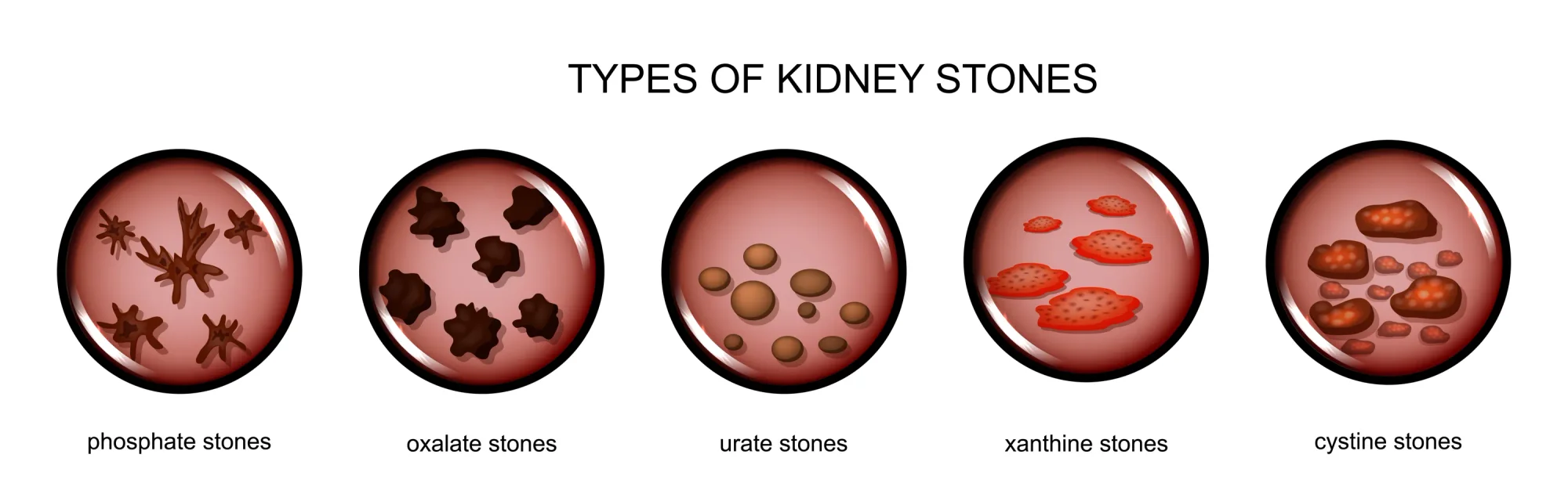 Vector illustration of types of kidney stones.