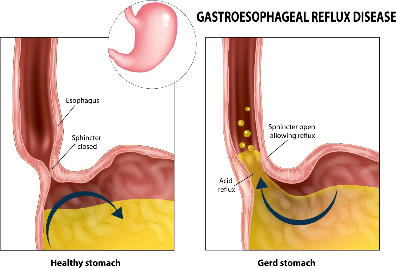 Graphic showing the difference between a healthy stomach and GERD stomach. Gastroesophageal reflux disease (Gerd or Heartburn). Acid reflux.