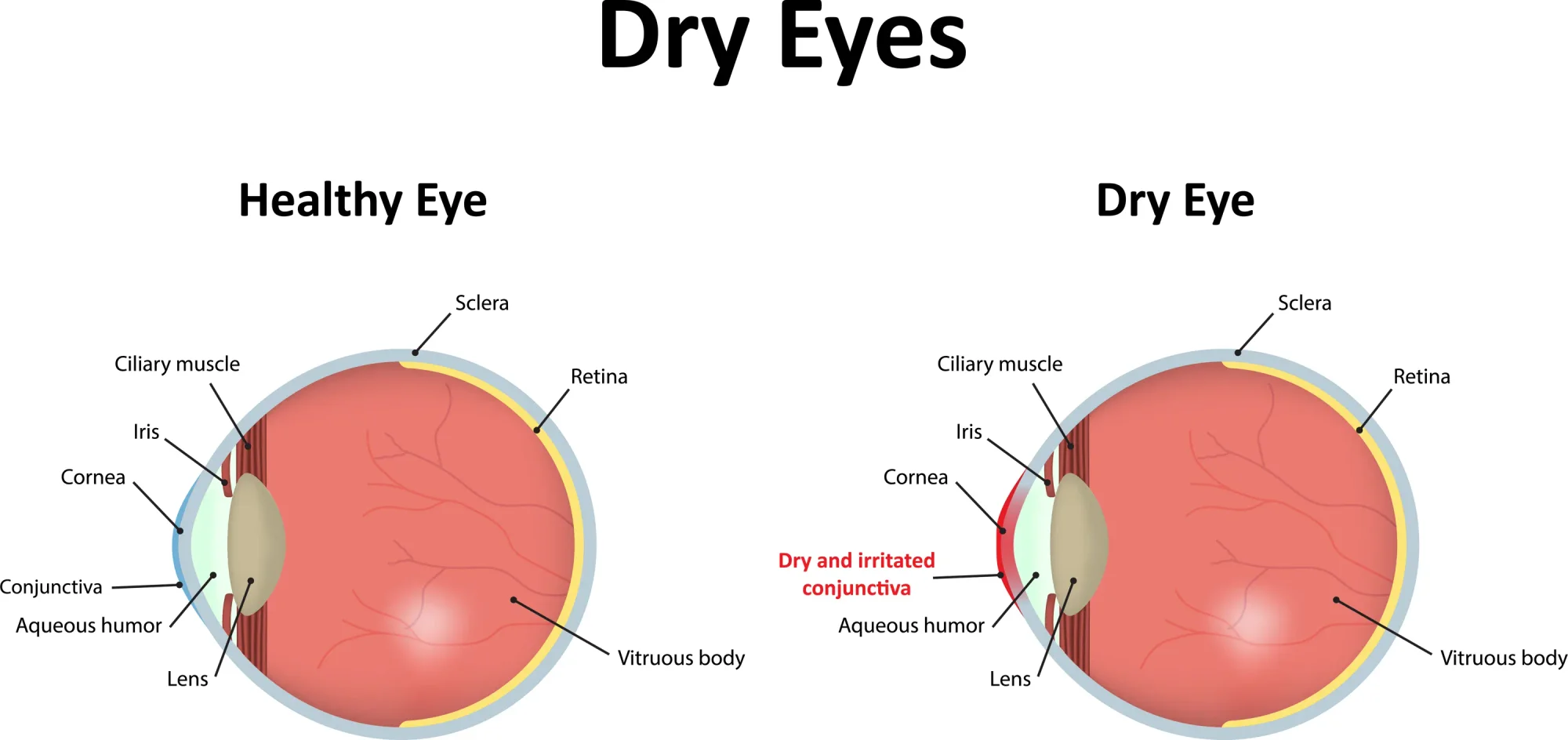 Graphic showing the difference between a healthy eye and a dry eye.