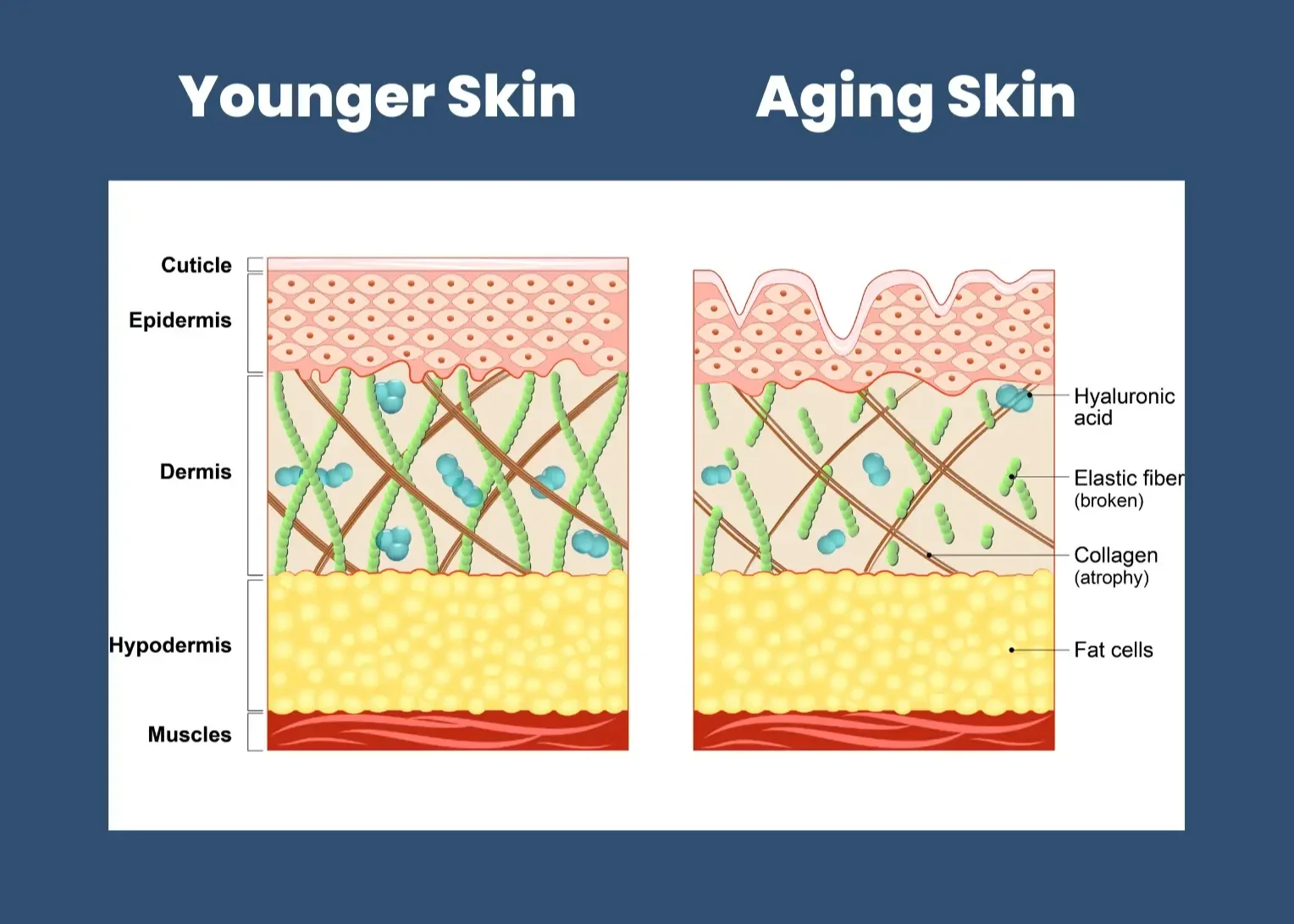 Illustration showing the difference between younger skin and older skin.