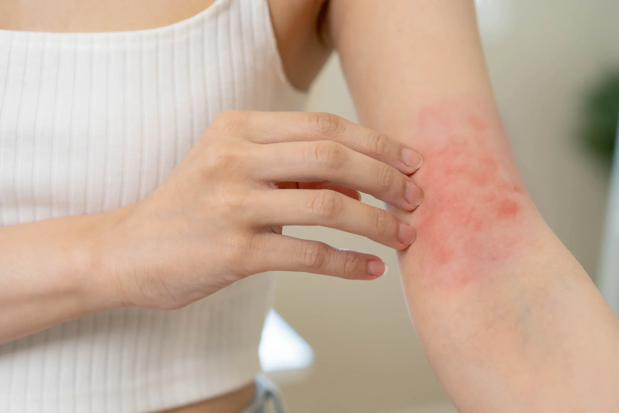 Young woman with a red rash on her arm from an autoimmune disease.