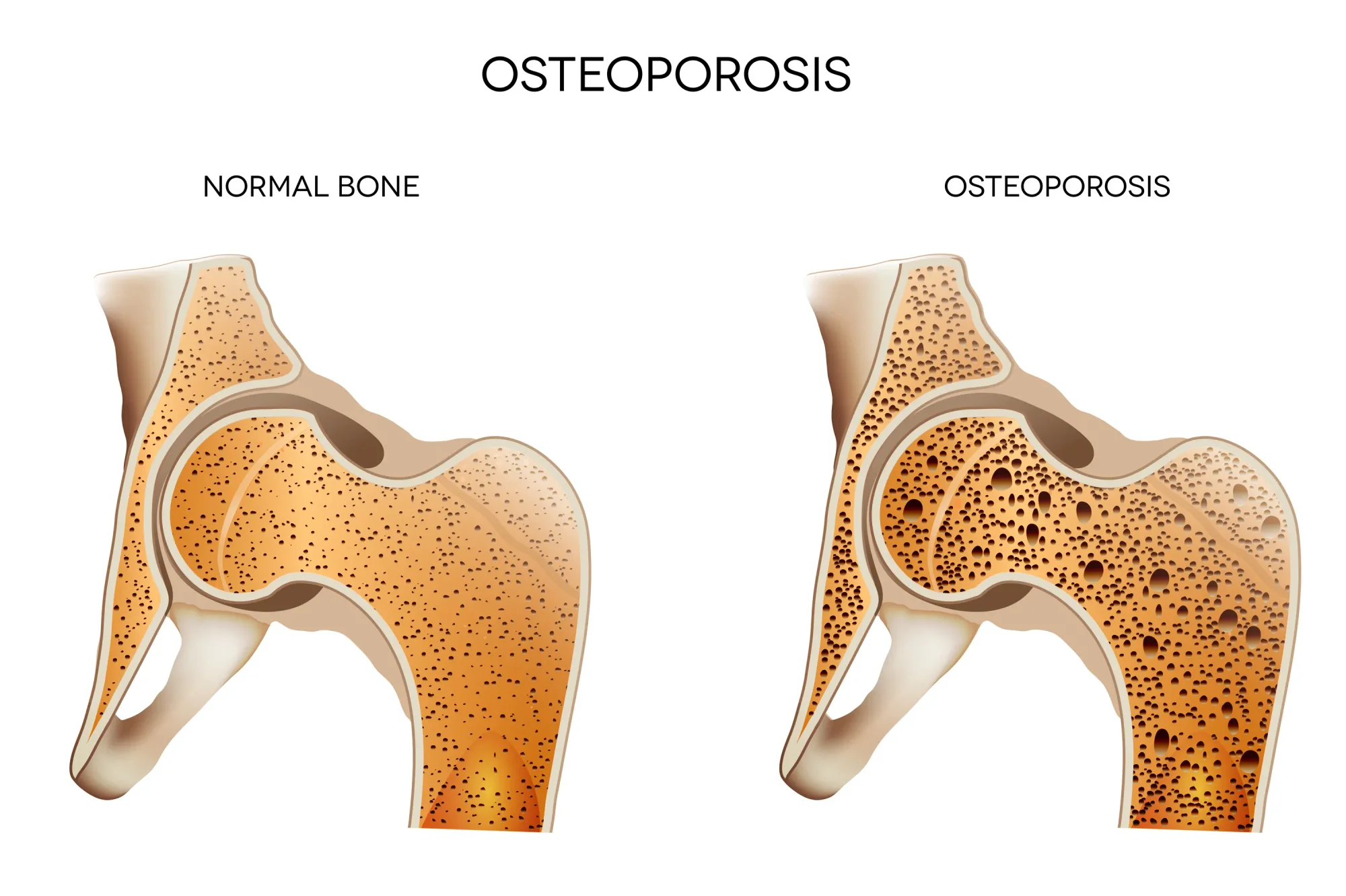Osteoporosis. Medical illustration healthy bone and unhealthy bone. Osteoporosis may lead to bone fracture.