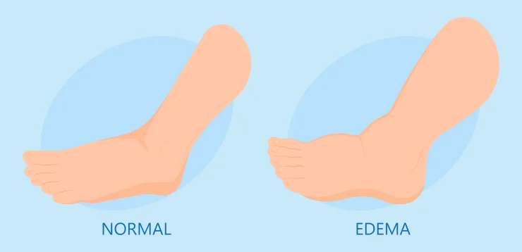 Graphic showing a normal foot vs a foot with edema. Swelling under the skin that affects the ankles and legs.