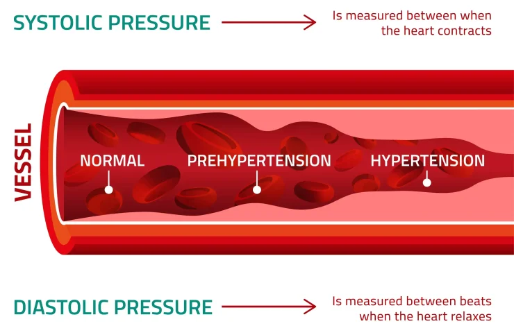 Animated graphic showing the difference between systolic pressure and diastolic pressure in the blood vessel. High blood pressure/hypertension animation.