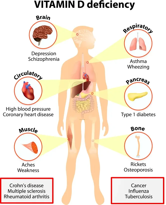 Vitamin D deficiency. symptoms and diseases caused by insufficient vitamin D. Symptoms & Signs. Human silhouette with highlighted internal organs