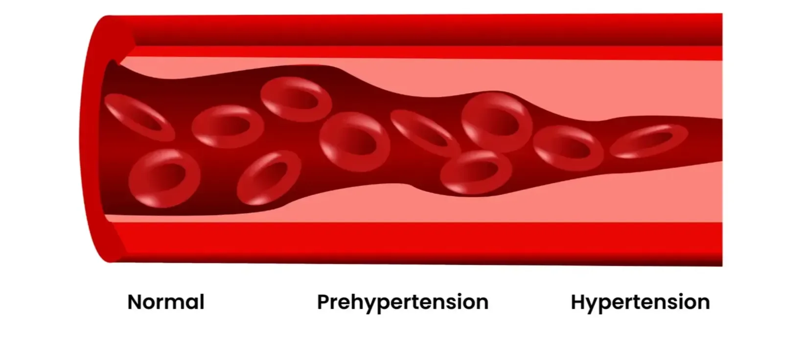 Animated graphic showing the progression of hypertension (high blood pressure). Norma > Prehypertension > Hypertension.