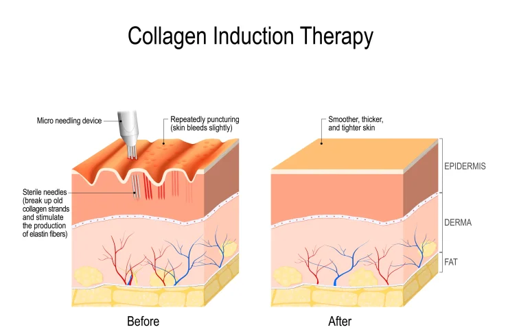 Collagen Induction Therapy Before and After