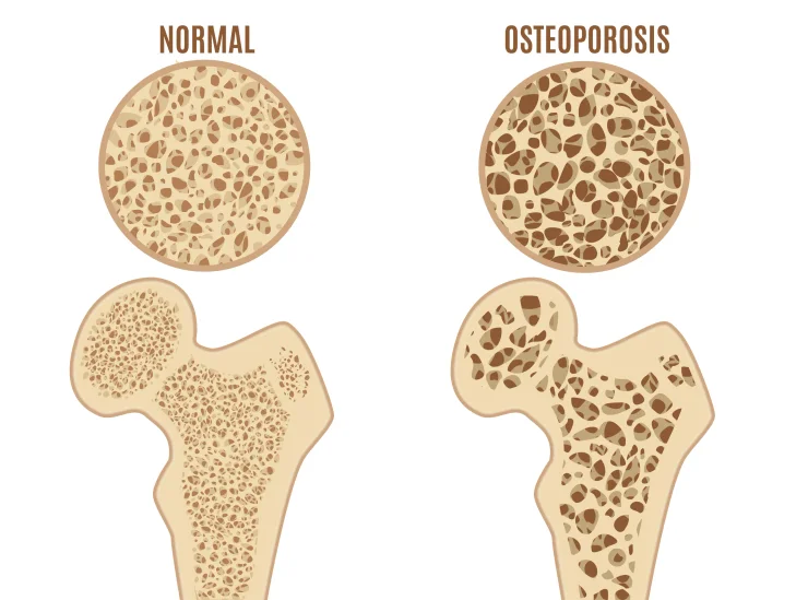 Infographic showing a normal, healthy bone versus a bone with osteoporosis.