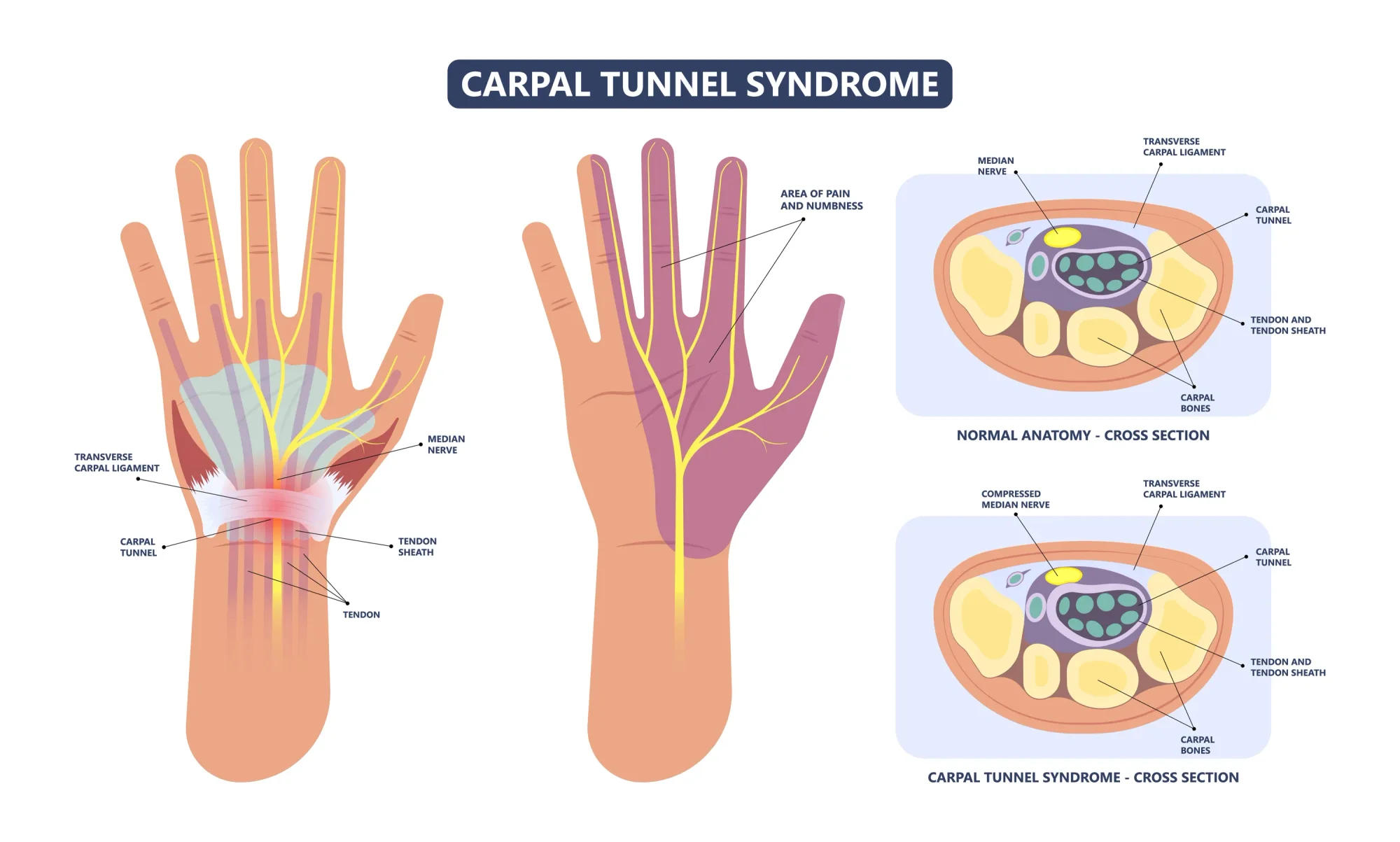 Animated graphic of hands with carpal tunnel syndrome.