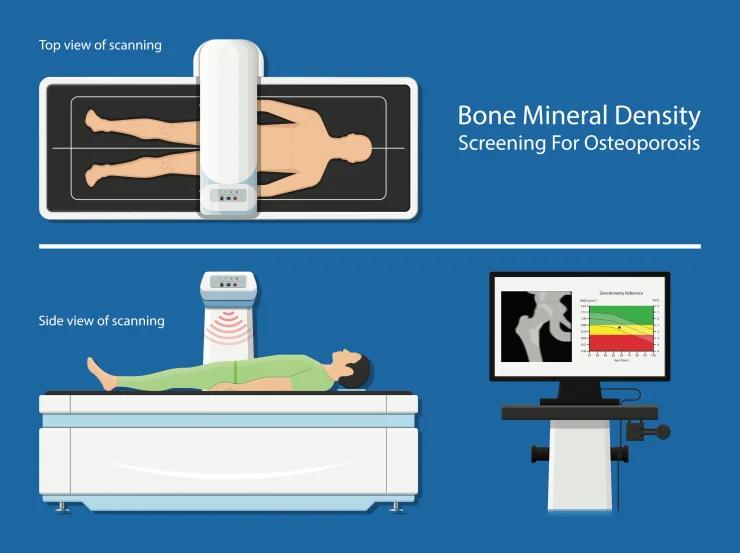 Bone mineral density (BMD) osteoporosis dual-energy X-ray absorptiometry adult disease equipment medical clinic central DEXA pain radiography hospital fragility risk examination