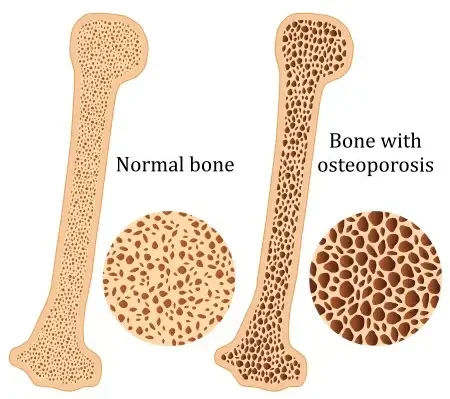 Normal Bone vs. Bone with Osteoporosis Graphic