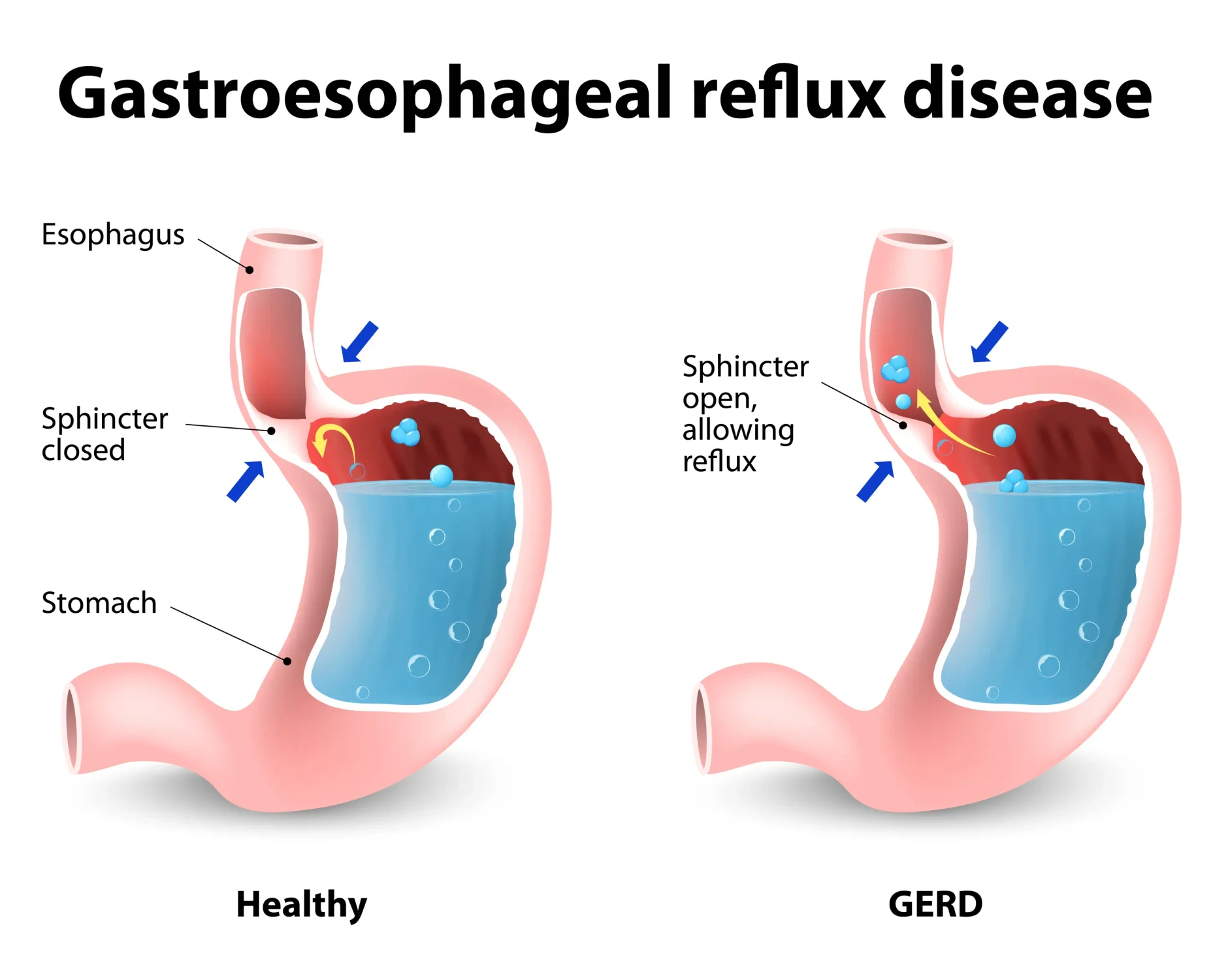 Illustration showing the difference between a healthy stomach and one with GERD. If the esophageal sphincter doesn't close tight enough, stomach acid seeps back into the esophagus, damaging it and causing heartburn.