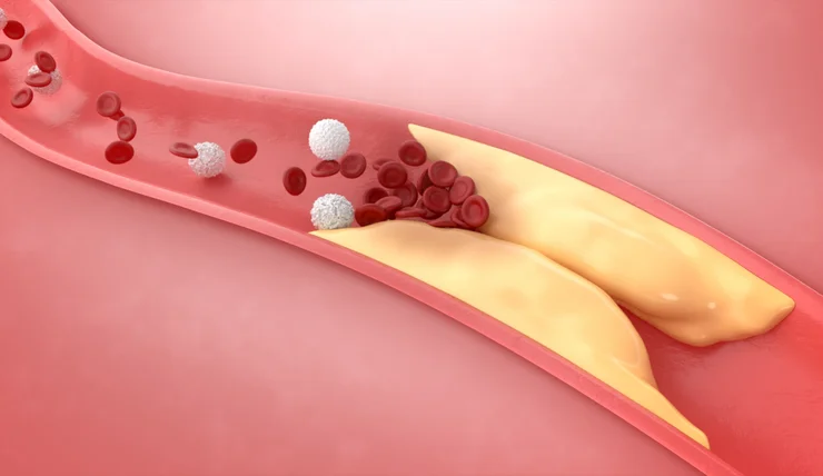 An illustrated rendering of atherosclerosis in the arteries