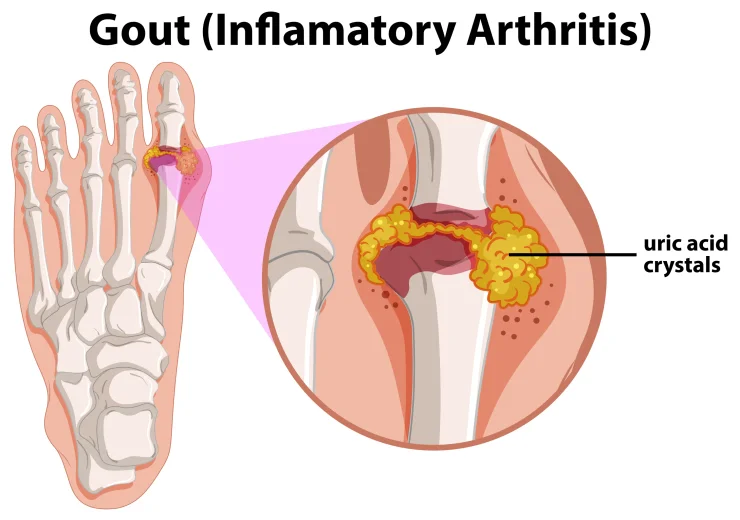 Diagram showing gout in human foot illustration.