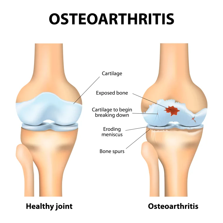 Osteoarthritis. Arthritis or pain within a joint. Degenerative joint disease. Cartilage becomes worn. This results in inflammation, swelling, and pain in the joint.