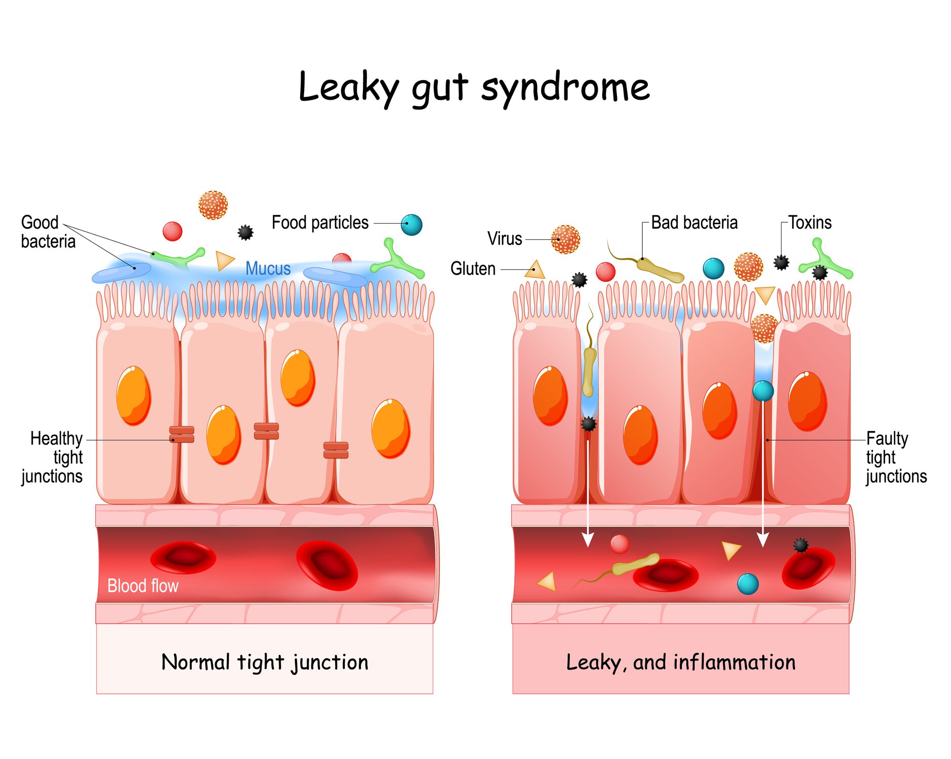 A infographic comparing a healthy guy lining with a leaky gut lining