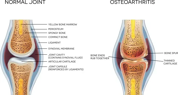 Animated graphic showing the difference between a normal joint and a joint with osteoarthritis.