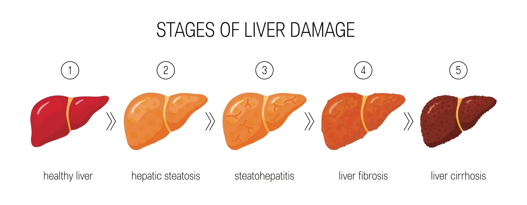 Stages of liver damage concept. Vector illustration of healthy liver, steatosis, NASH, fibrosis and cirrhosis in cartoon style.