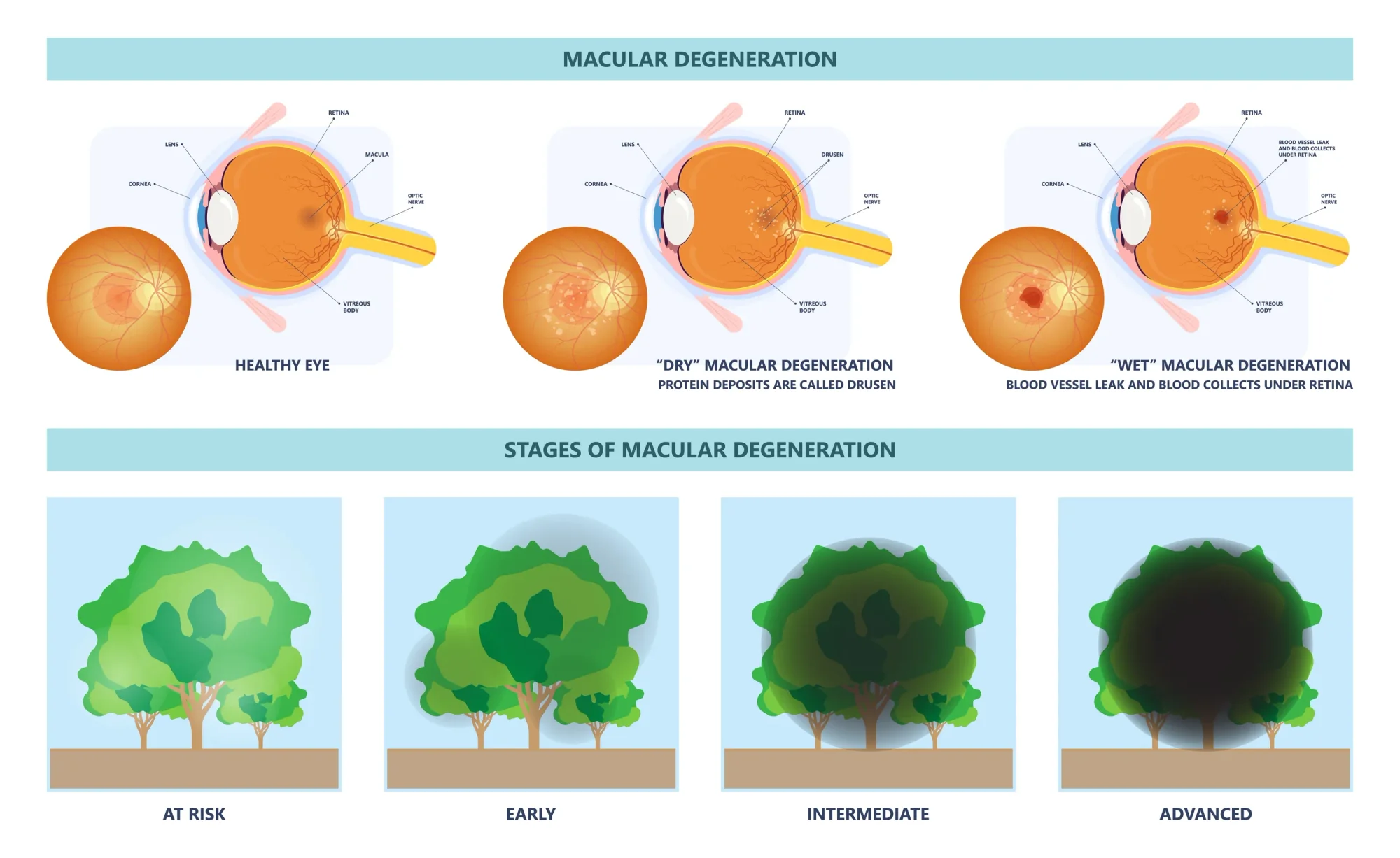 Animated graphic showing the difference between a healthy eye and one with dry macular degeneration or wet macular degeneration.