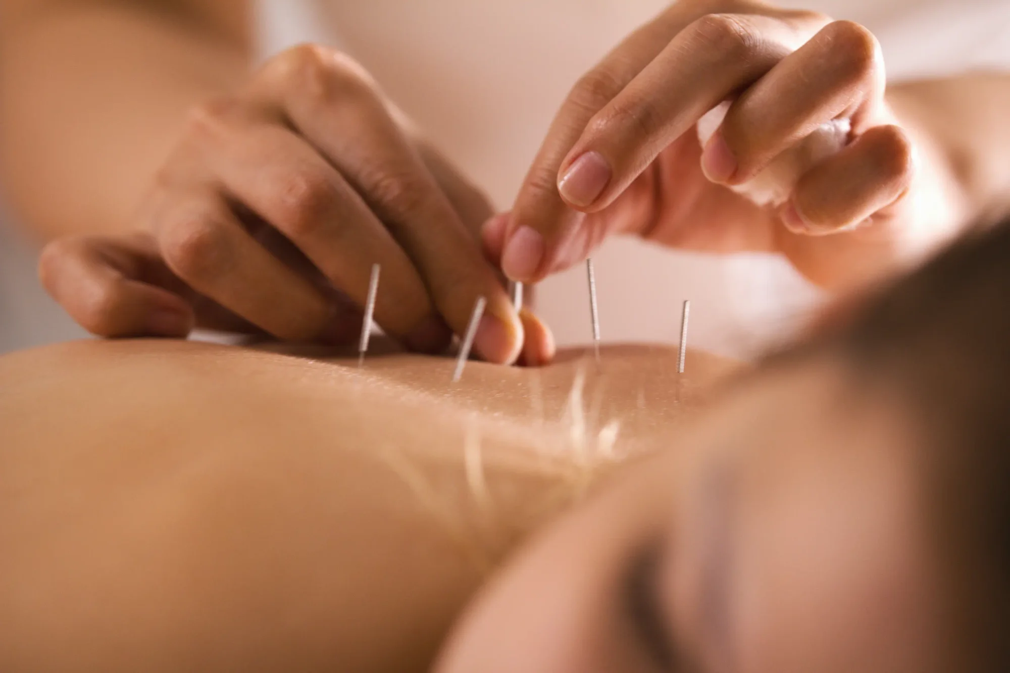 Woman getting acupuncture for neuropathy.