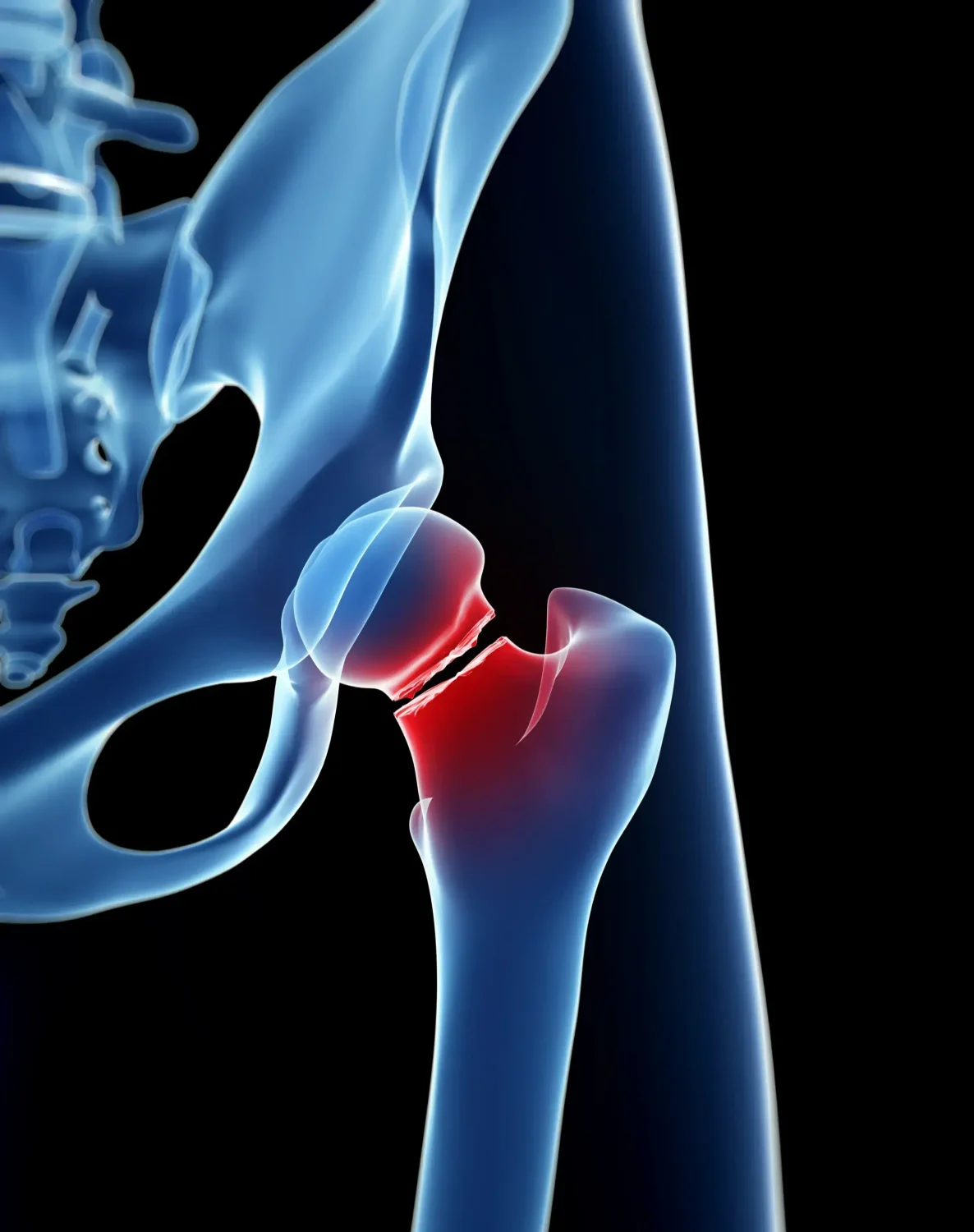 Graphic showing the femoral neck of a broken hip glowing in red.