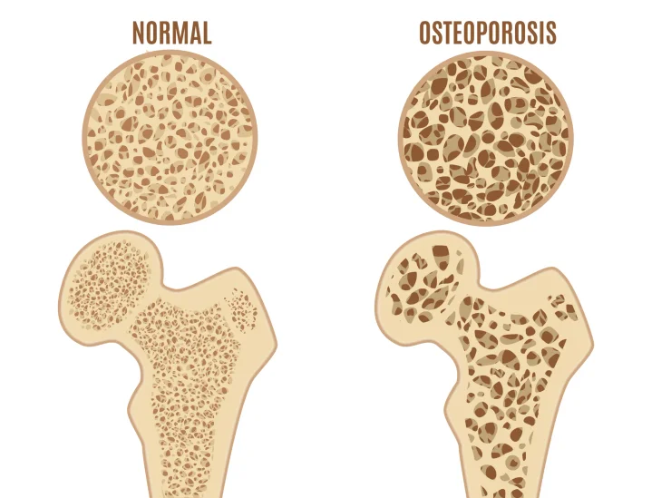 Normal Vs. Osteoporosis Bones Strengthen Non-Dairy Collagen