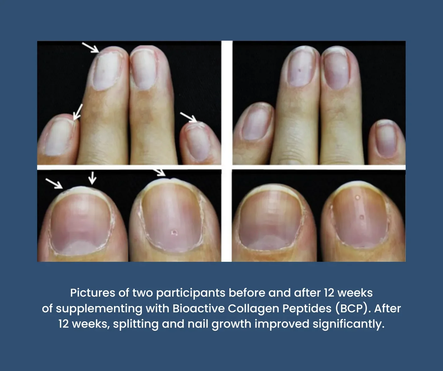 Before and after pictures of finger nails from participants taking Bioactive Collagen Peptides.