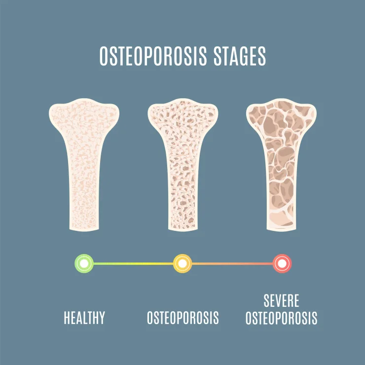 Osteoporosis process infographic of bone tissue close-up with different density. Skeletal system disease stages. Senior osteopathy medical concept. Vector illustration.