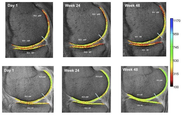 MRI images of study participants knees on Day 1, Weeks 24, and Weeks 48 of the study. The control participant's images are on the top row and the collagen participant's images are on the bottom row.