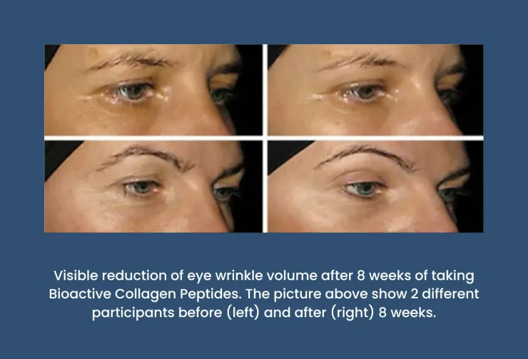 Before and after pictures of the eye wrinkles in two participants taking Bioactive Collagen Peptides.
