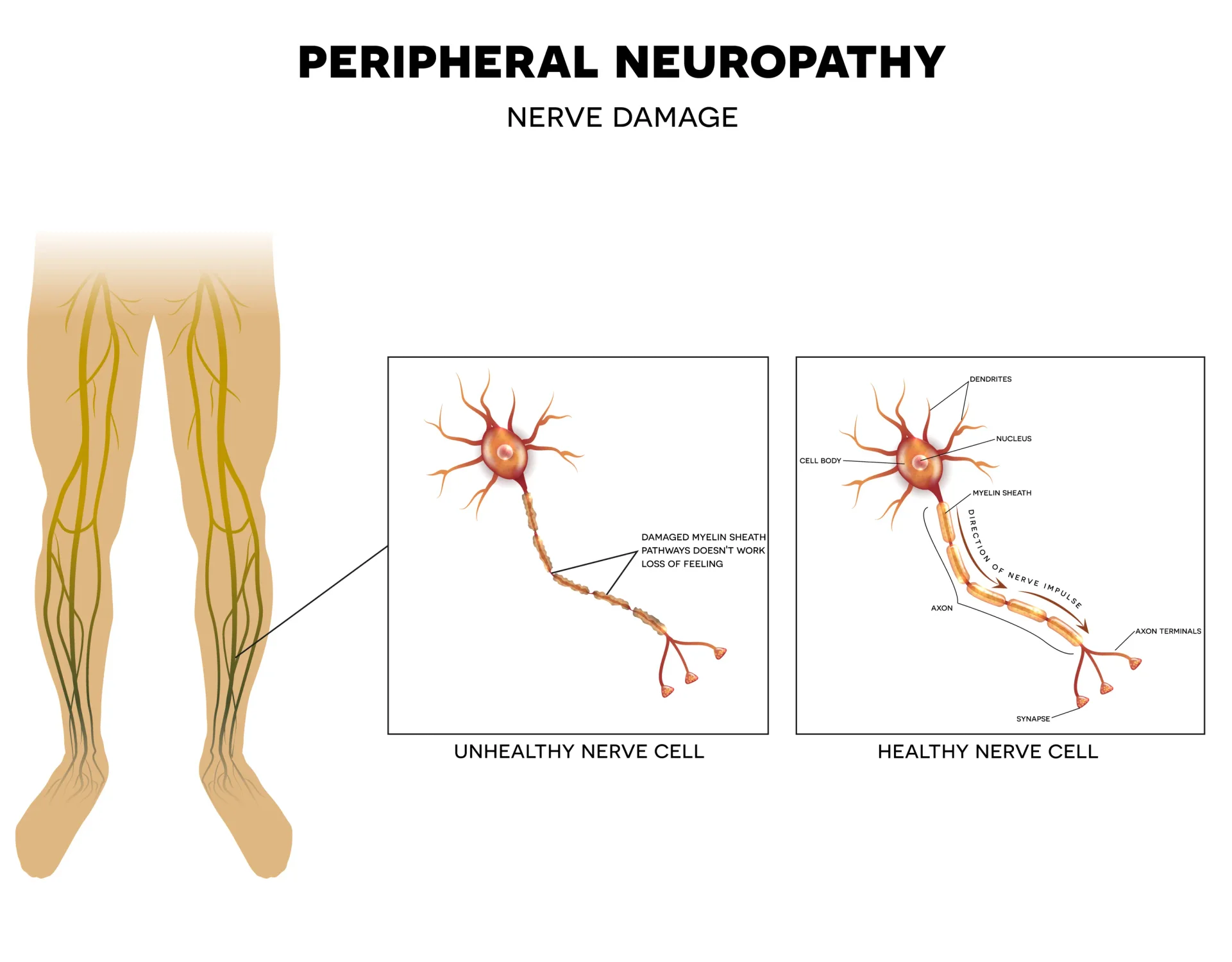 Graphic animation of peripheral neuropathy. Unhealthy nerve cell vs. healthy nerve cell.