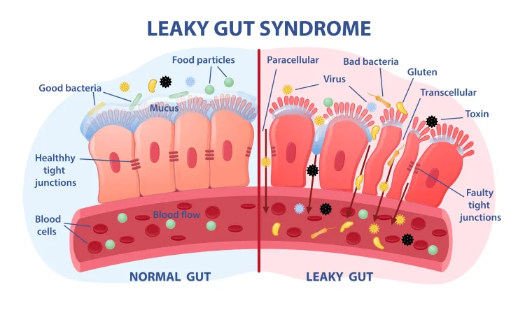 Leaky Gut Syndrome concept. Comparison of a healthy digestive system and inflamed tissue cells. Diseases of the gastrointestinal tract. Toxins and viruses. Cartoon flat vector illustration isolated on white background.