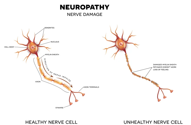 Animated graphic showing the difference between a healthy nerve cell and unhealthy nerve cell to describe neuropathy.