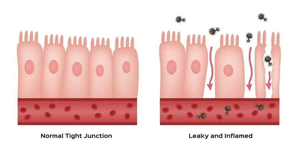 Normal Tight Junction vs. Leaky and Inflamed