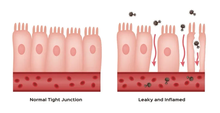 Normal Tight Junction vs. Leaky and Inflamed