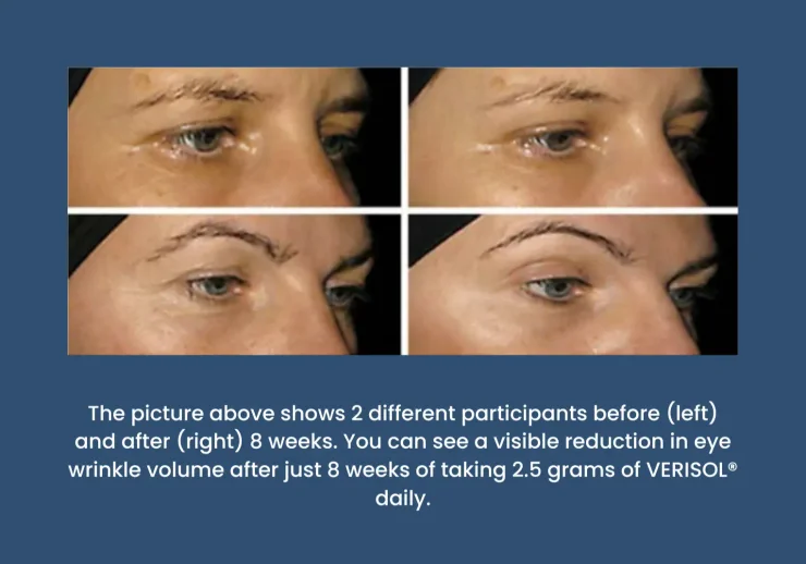 Before and after pictures of two different participants taking 2.5 grams of VERISOL® daily for 8 weeks.