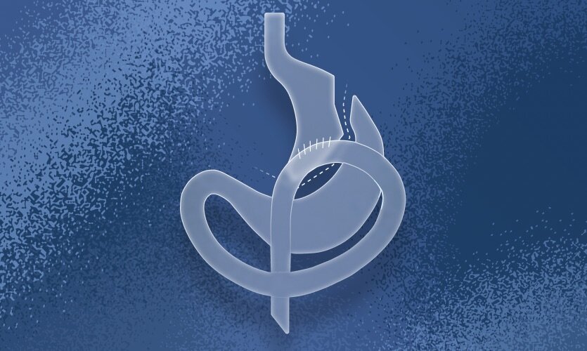 WLS Primo, multivitamin for a Mini Gastric Bypass