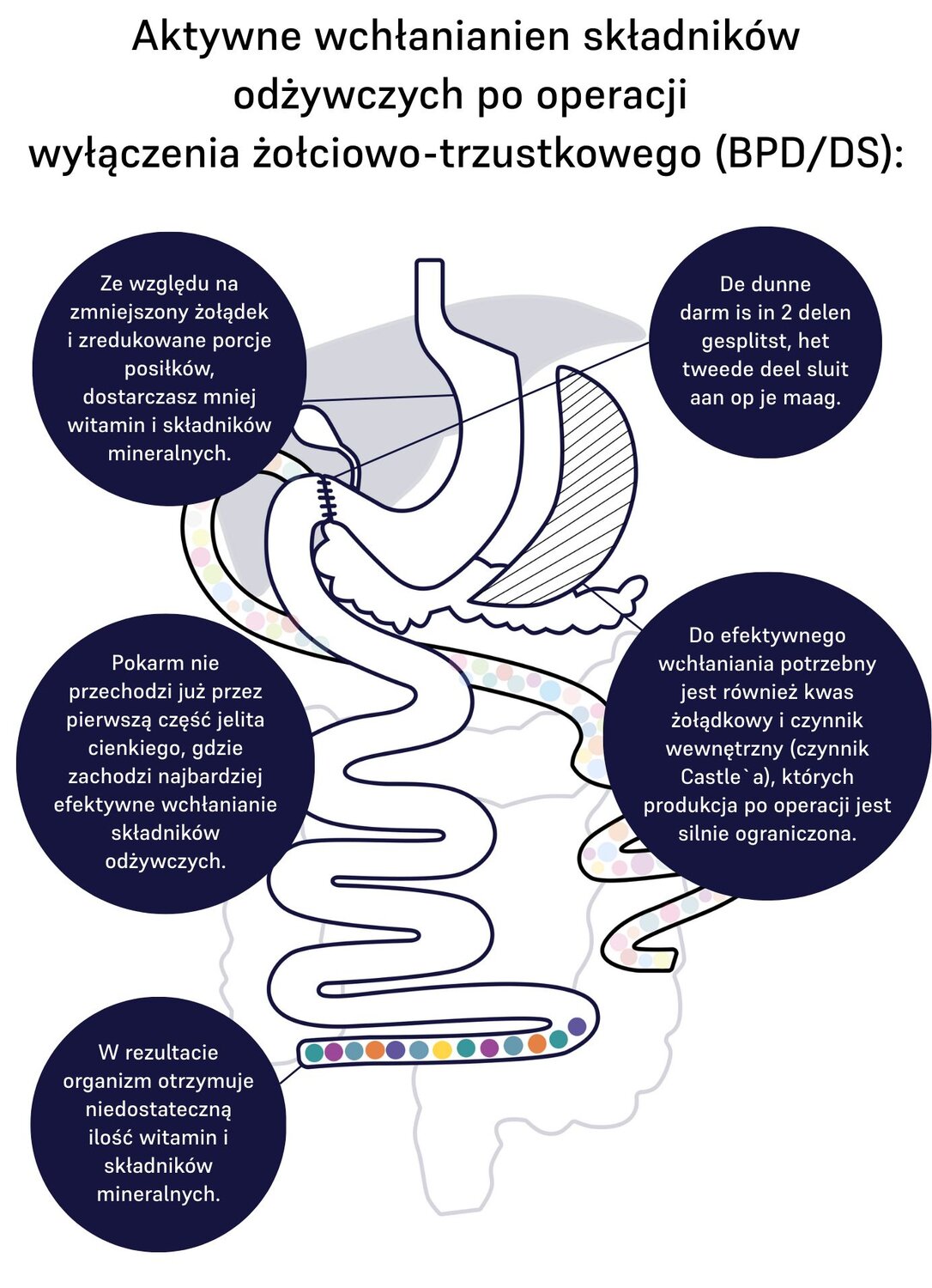 Image of absorption of nutrients for duodenal switch 