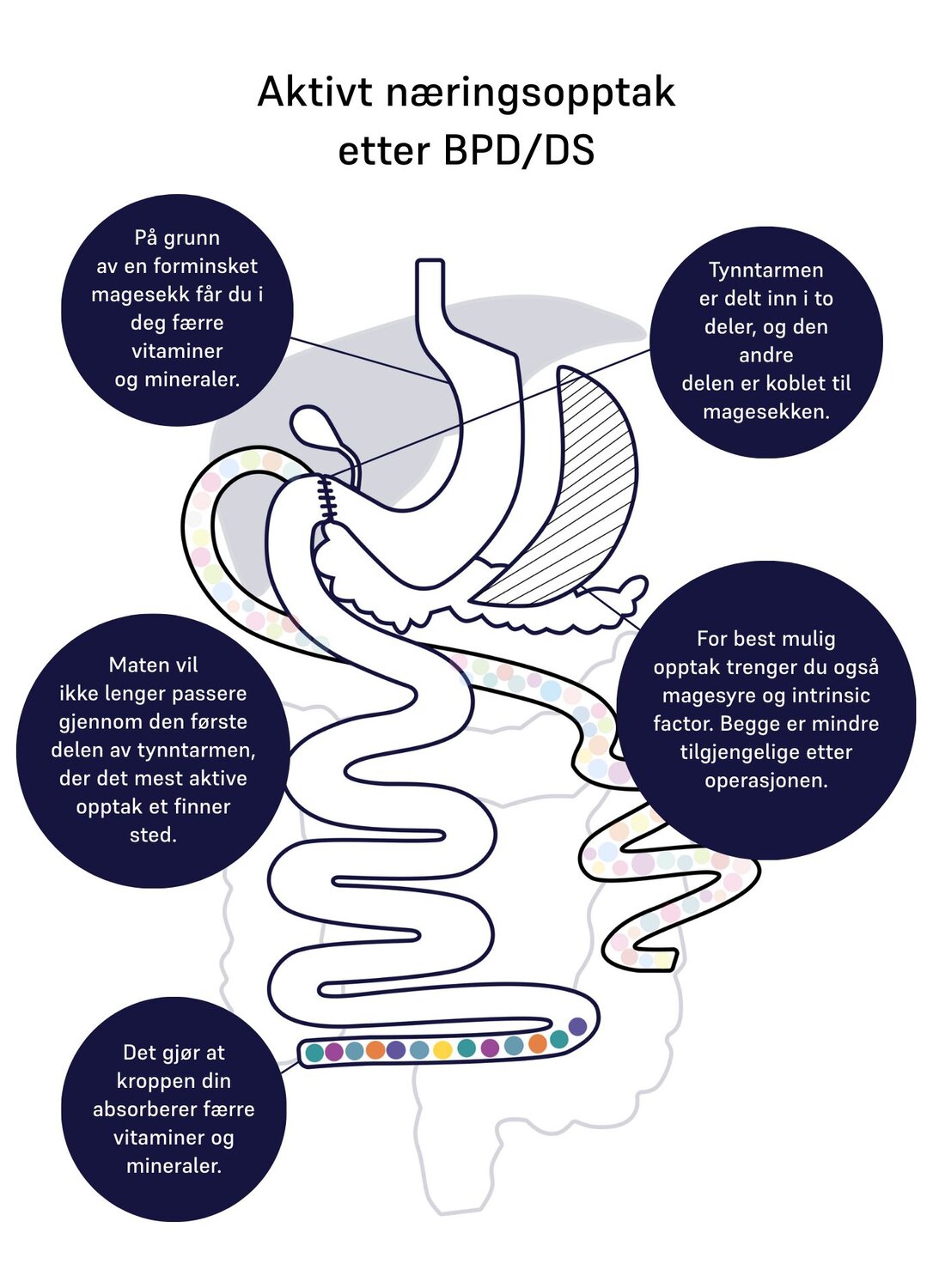 Image of absorption of nutrients for duodenal switch 