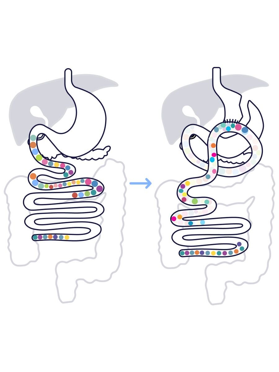 Before and After Omega Loop Gastric Bypass