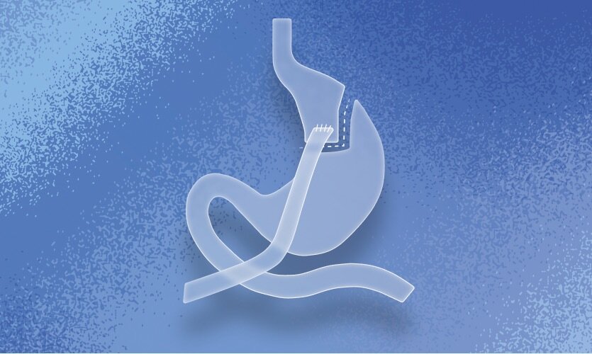 WLS Forte, your multivitamin for a Gastric Bypass