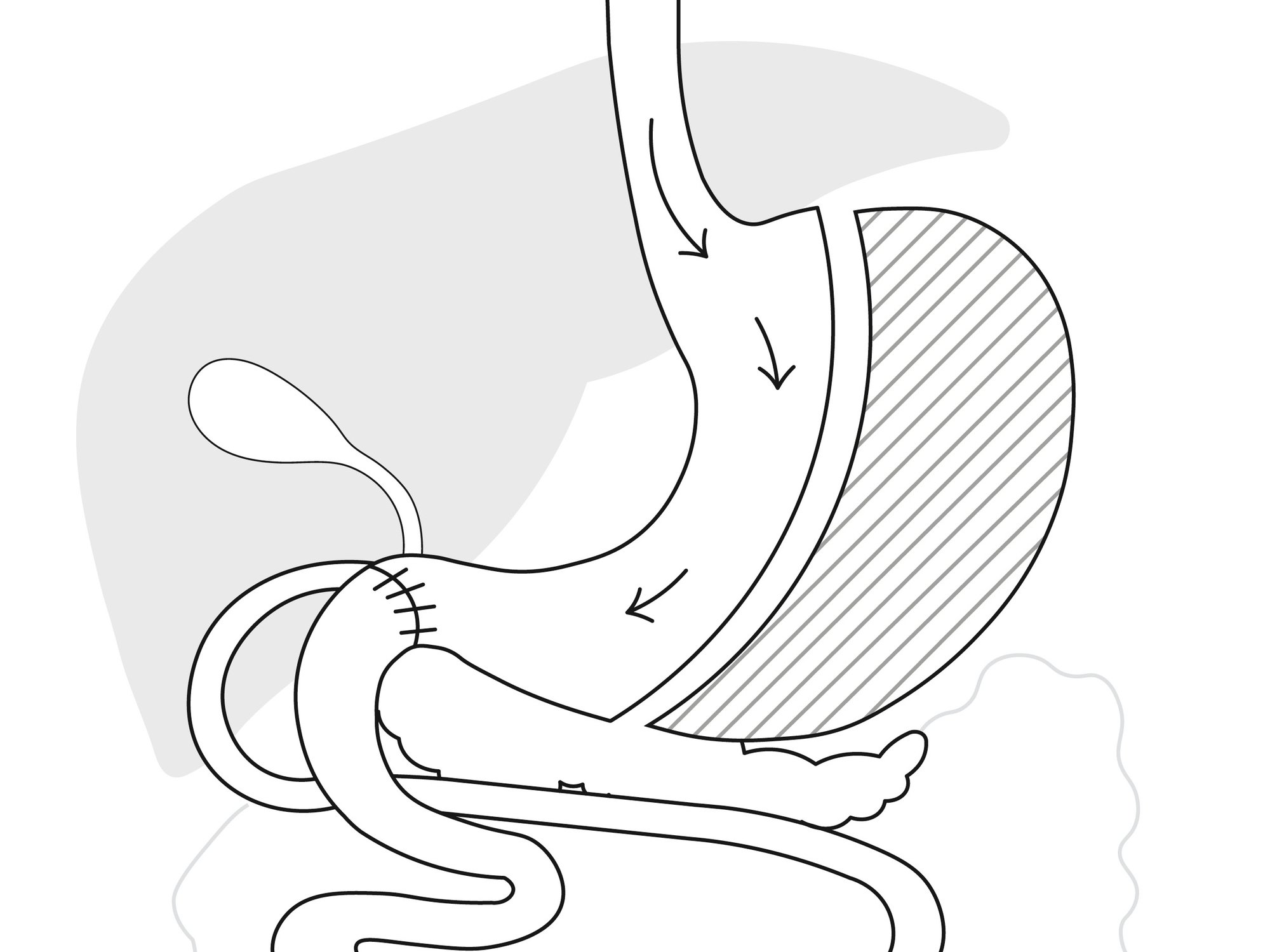 After a Biliopancreatic Diversion/Duodenal Switch, your stomach will be smaller