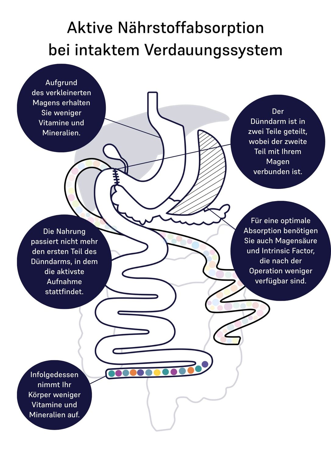 Image of absorption of nutrients for duodenal switch 