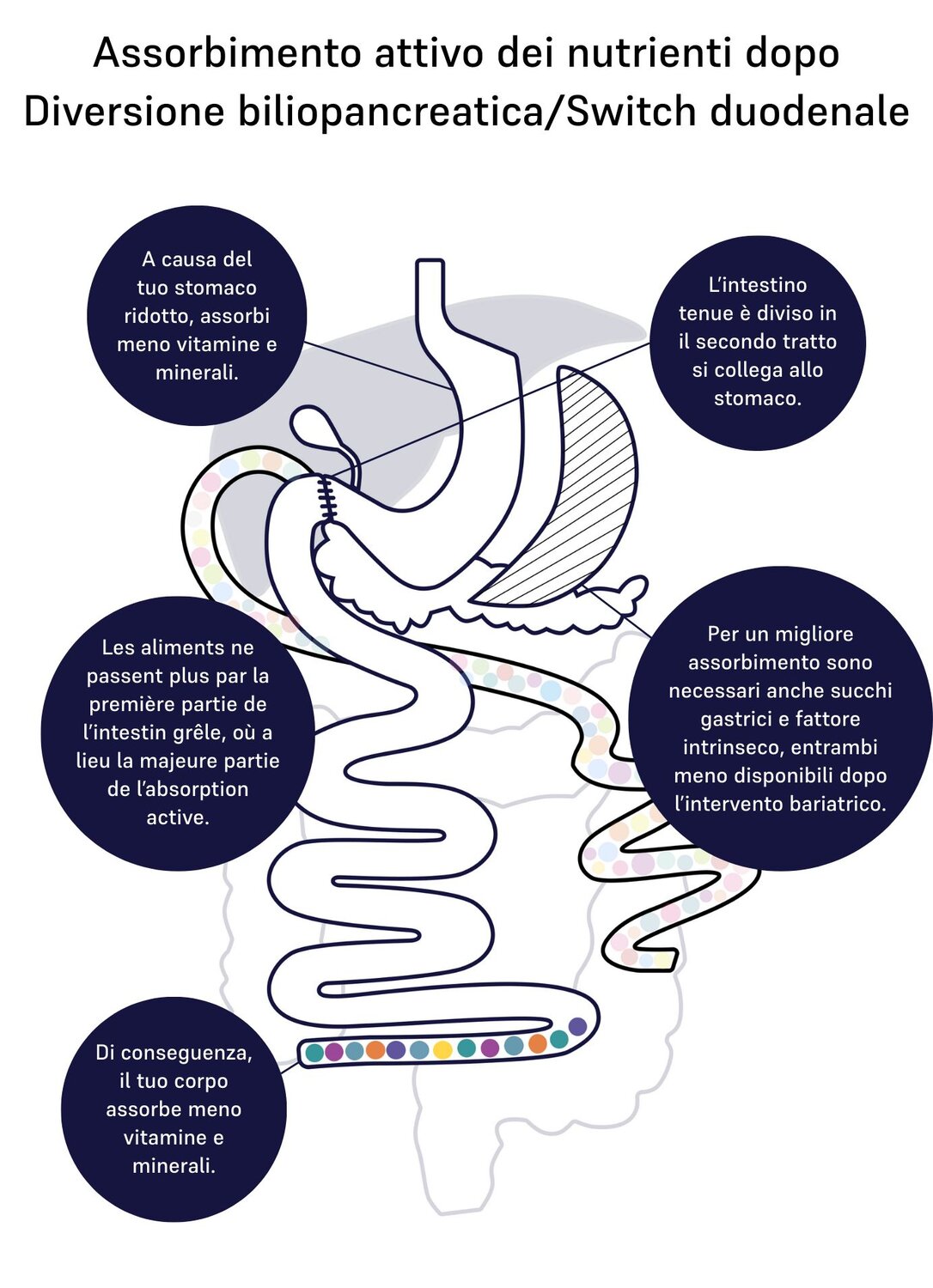 Image of absorption of nutrients for duodenal switch 